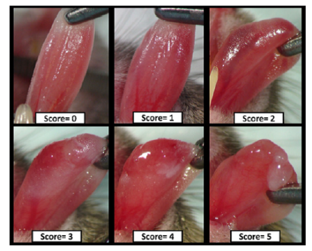 Escala para estimar la mucositis oral inducida por radioterapia.